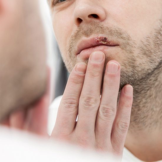 Kissing with cold sores